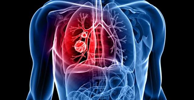 Le cancer - Un coût de plus de 4 G$ en 2013 : Un risque d'effondrement du système