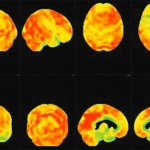 Une nouvelle technique d'imagerie cérébrale pour mieux détecter les démences