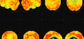 Une nouvelle technique d'imagerie cérébrale pour mieux détecter les démences