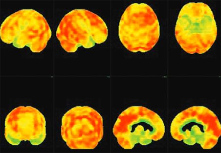 Une nouvelle technique d'imagerie cérébrale pour mieux détecter les démences